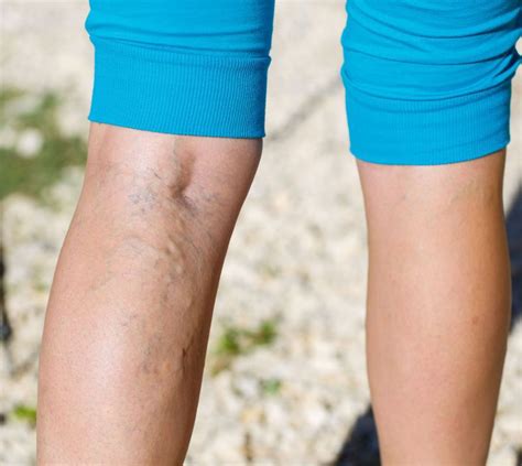 simptome ale bolii picioarelor cu varice